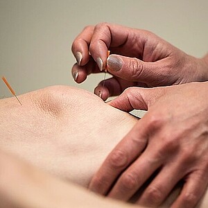Bild von Akupunkturbehandlung zur Förderung der Gesundheit und des Wohlbefindens.