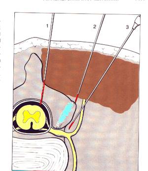 Röntgen-gestützte Infiltrationstherapie (periradikulär), Dr. E. Milewski, Dr. T. Milewski, Regensburg Röntgen-gestützte Infiltrationstherapie (periradikulär), Dr. E. Milewski, Dr. T. Milewski, Regensburg
